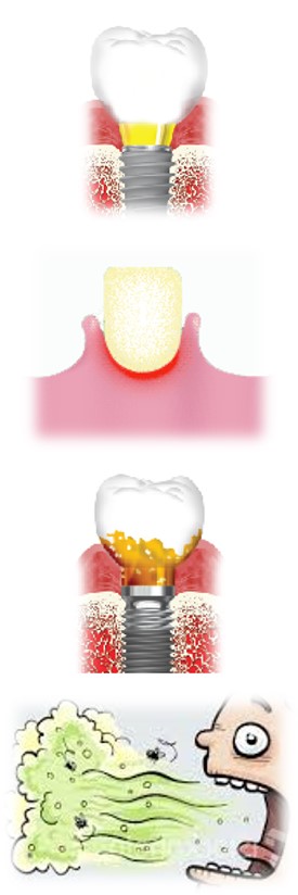 Hygiène bucco-dentaire, brosse sonique, brossette interdentaire, tartre, plaque dentaire, nettoyage sonique, espaces interdentaires, LED, résidus alimentaires, couronnes, bridges, prothèses, déchaussement, bagues orthodontiques, France, Var